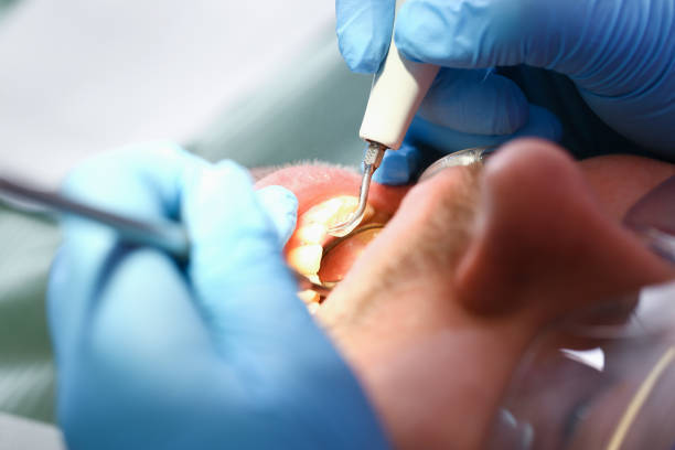 Best Emergency Tooth Extraction in Blackwell, OK