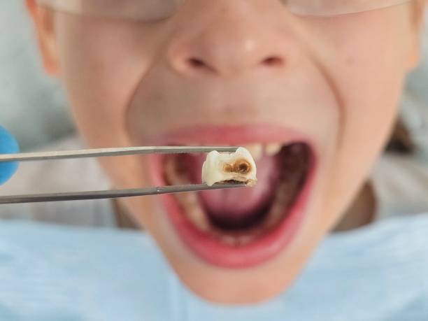 Best Emergency Tooth Extraction in Blackwell, OK